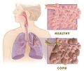 COPD versus healthy lung