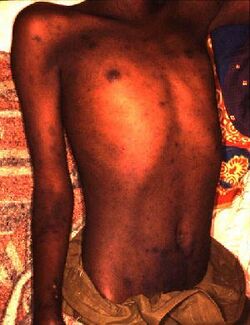 Epidemic typhus Burundi