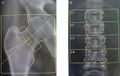 DXA scan of Morbus Fabry