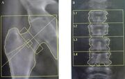 Dual-energy X-ray absorptiometry (DEXA) assessment of bone mineral density of the femoral neck