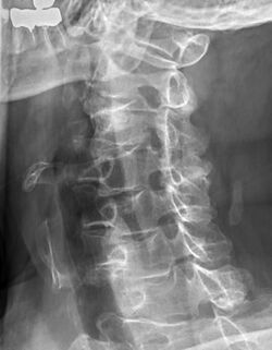 Projectional radiograph of cervical foraminal stenosis