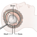 Decompressive craniectomy