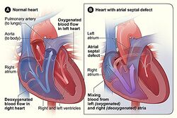 Atrial septal defect