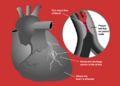 Diagram illustrating a heart attack