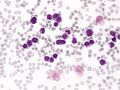 Micrograph of acute megakaryoblastic leukemia