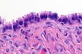 Ovarian tumor
