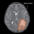 MRI of Central nervous system primitive neuroectodermal tumor