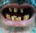 Tired teeth