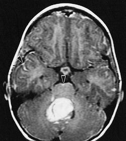 MEDULLOBLASTOMA RADIOLOGY