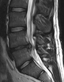 Disc herniation