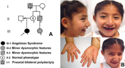 Angelman syndrome