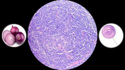 Castelman disease