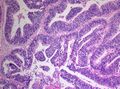 Histology of Medulloepithelioma