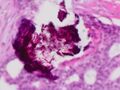 Microcalcification