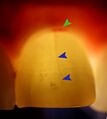 Enamel fracture