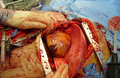 Emergency Thoracotomy