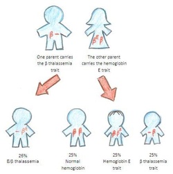 HbE betaThalassemia trait