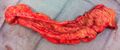 Resected ileum