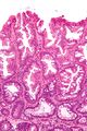 Sessile serrated adenoma, very high magnification