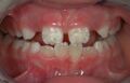 Tooth enamel