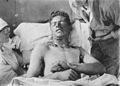 Mustard gas burns