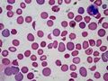 DIC With Microangiopathic Hemolytic Anemia