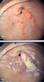 Gastric antral vascular ectasia (before and after)
