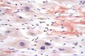 Cardiac amyloidosis under very high magnification