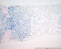 Hemochromatosis liver iron stained with Prussian blue