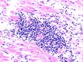 Viral myocarditis