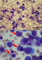 Bone marrow smear with May-Grünwald–Giemsa staining