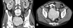 Castleman's disease Preoperative CT scan of the abdomen showing a highly vascularized retroperitoneal tumor measuring 10 √ó 9.2 cm with intratumor calcifications