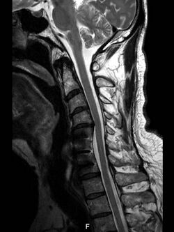 Cervical spine after surgery