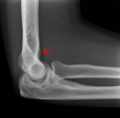 Anterior fat pad