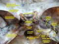 Dissection showing the temporal bone.