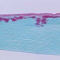 Mutated transforming growth factor beta induced protein in the superficial corneal stroma