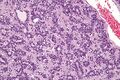 High magnification of adenomyoepithelioma
