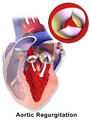 Aortic regurgitation illustration