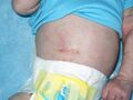 Pyloromyotomy