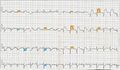 12 Lead EKG ST Elevation tracing color coded
