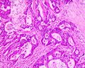 Adenocarcinoma coli (well differentited)
