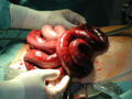 Ileus