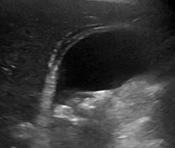 Ultrasonography of cholecystitis