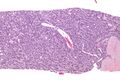 Low magnification of adenomyoepithelioma