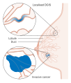 Diagram showing ductal carcinoma in situ (DCIS)
