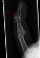 Broken_finger