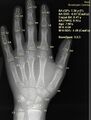 X-ray of hand with bone age analysis by BoneXpert software