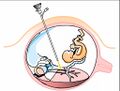 Fetal surgery
