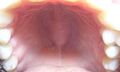 Oral_torus
