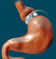 Bariatric surgery